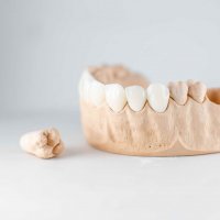 Художественная реставрация зуба